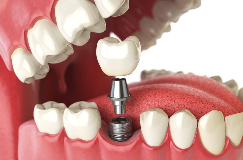 Implante dentário